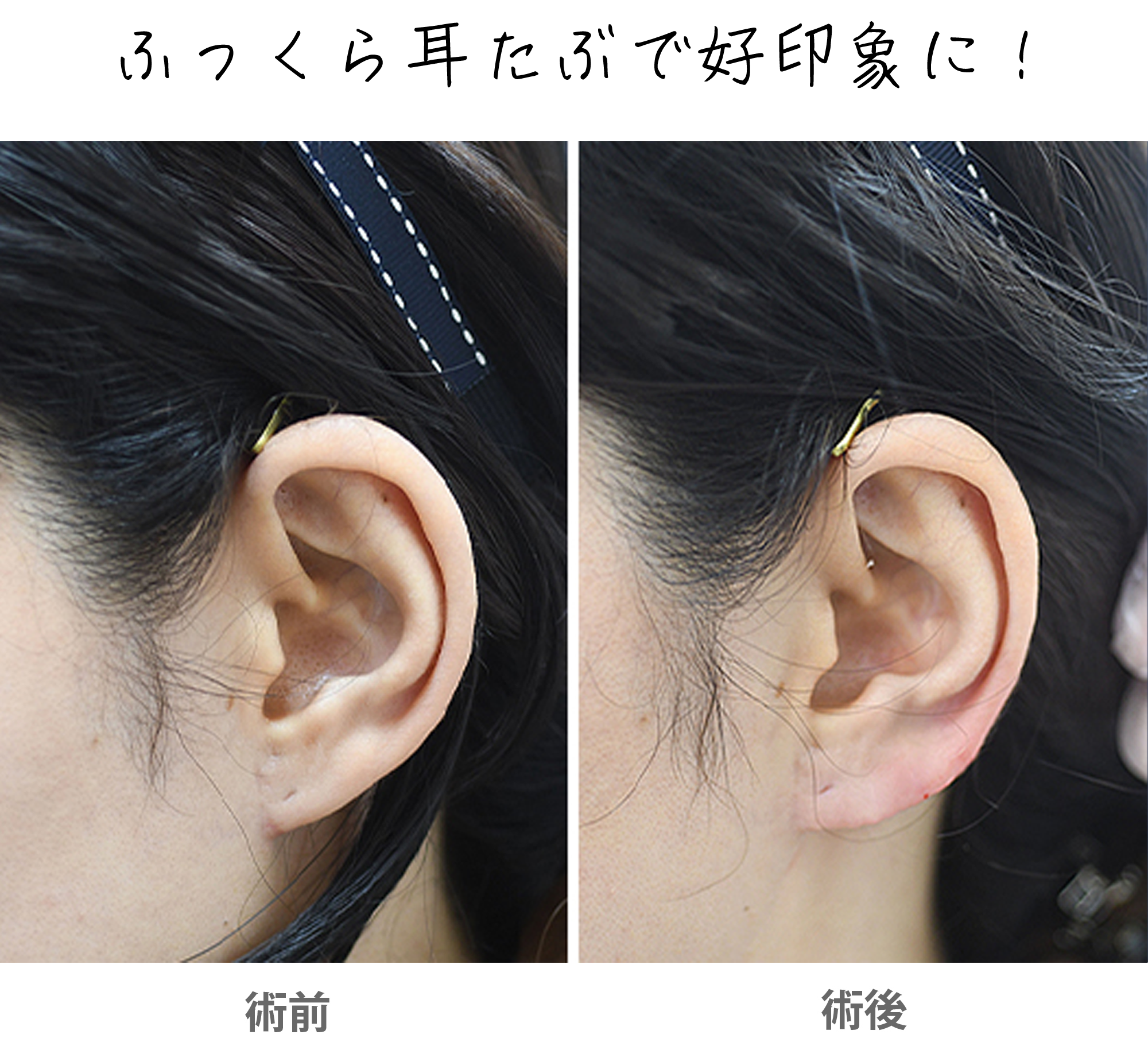 「立ち耳ヒアルロン酸（立ち耳フィラー）」の症例写真・ビフォーアフター