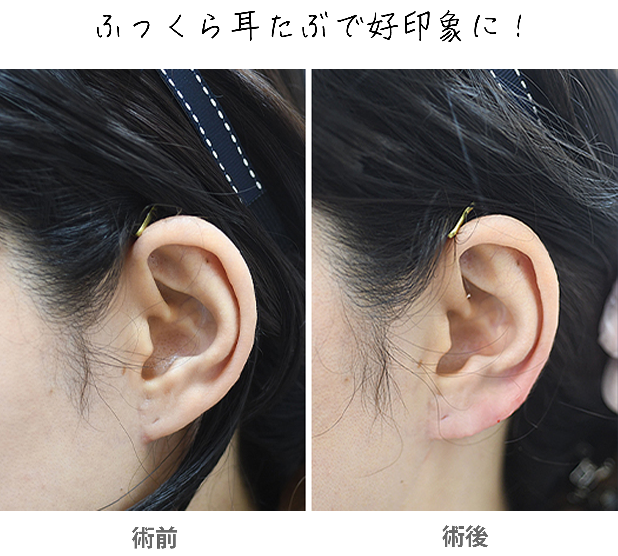「立ち耳ヒアルロン酸（立ち耳フィラー）」の症例写真・ビフォーアフター