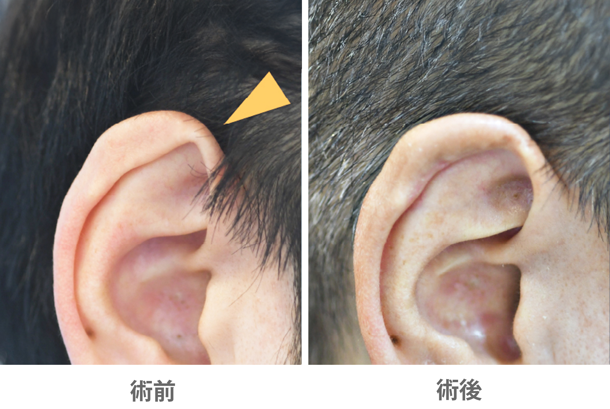 「耳輪形成」の症例写真・ビフォーアフター