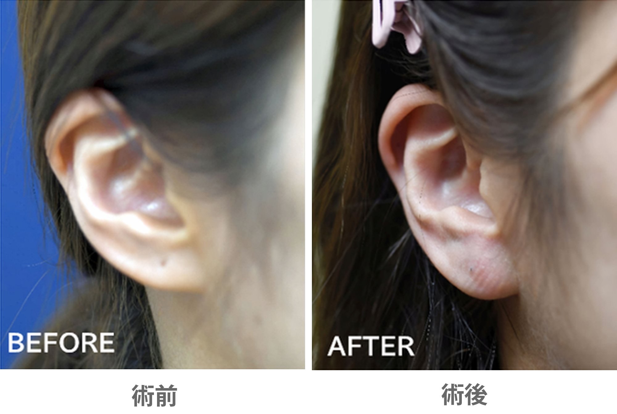 「福耳形成」の症例写真・ビフォーアフター