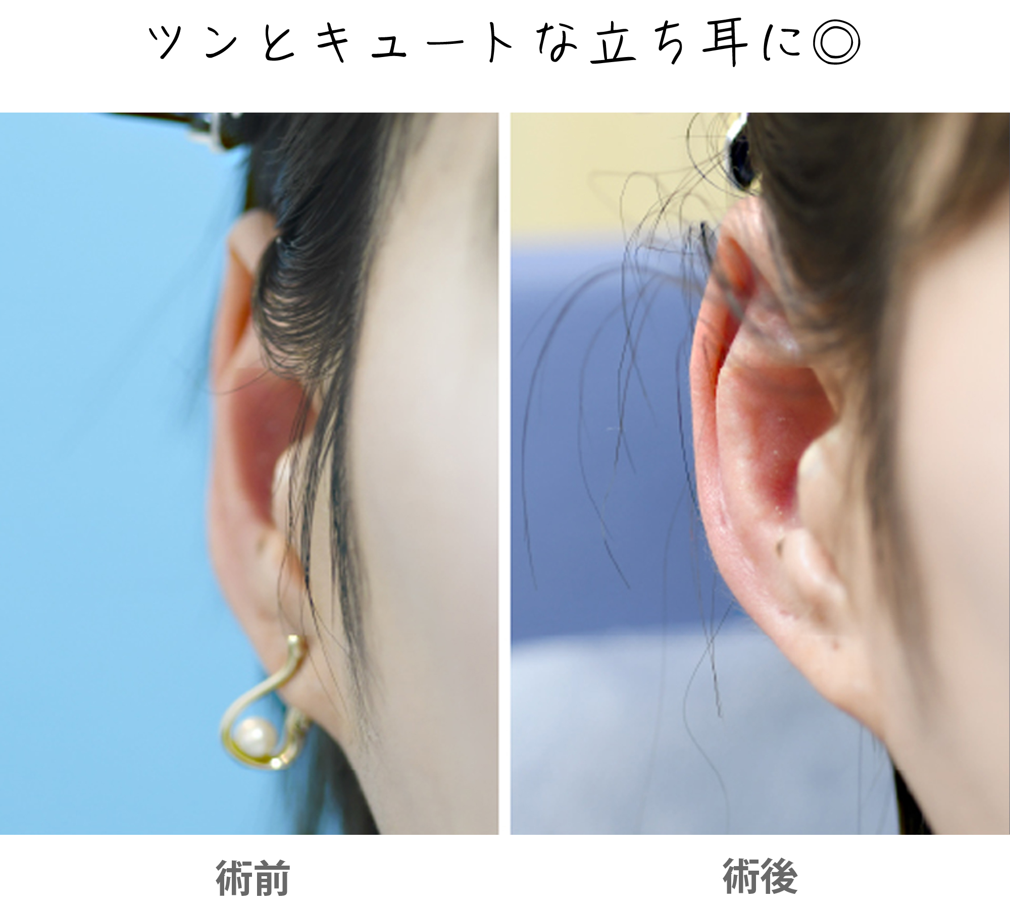 「立ち耳整形（立ち耳にする整形）」の症例写真・ビフォーアフター