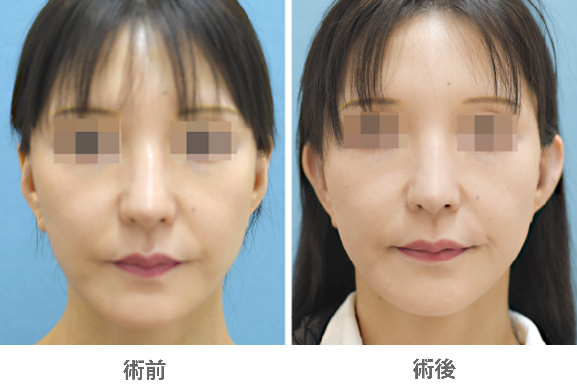 「立ち耳整形（片耳／左右差を整える）」の症例写真・ビフォーアフター