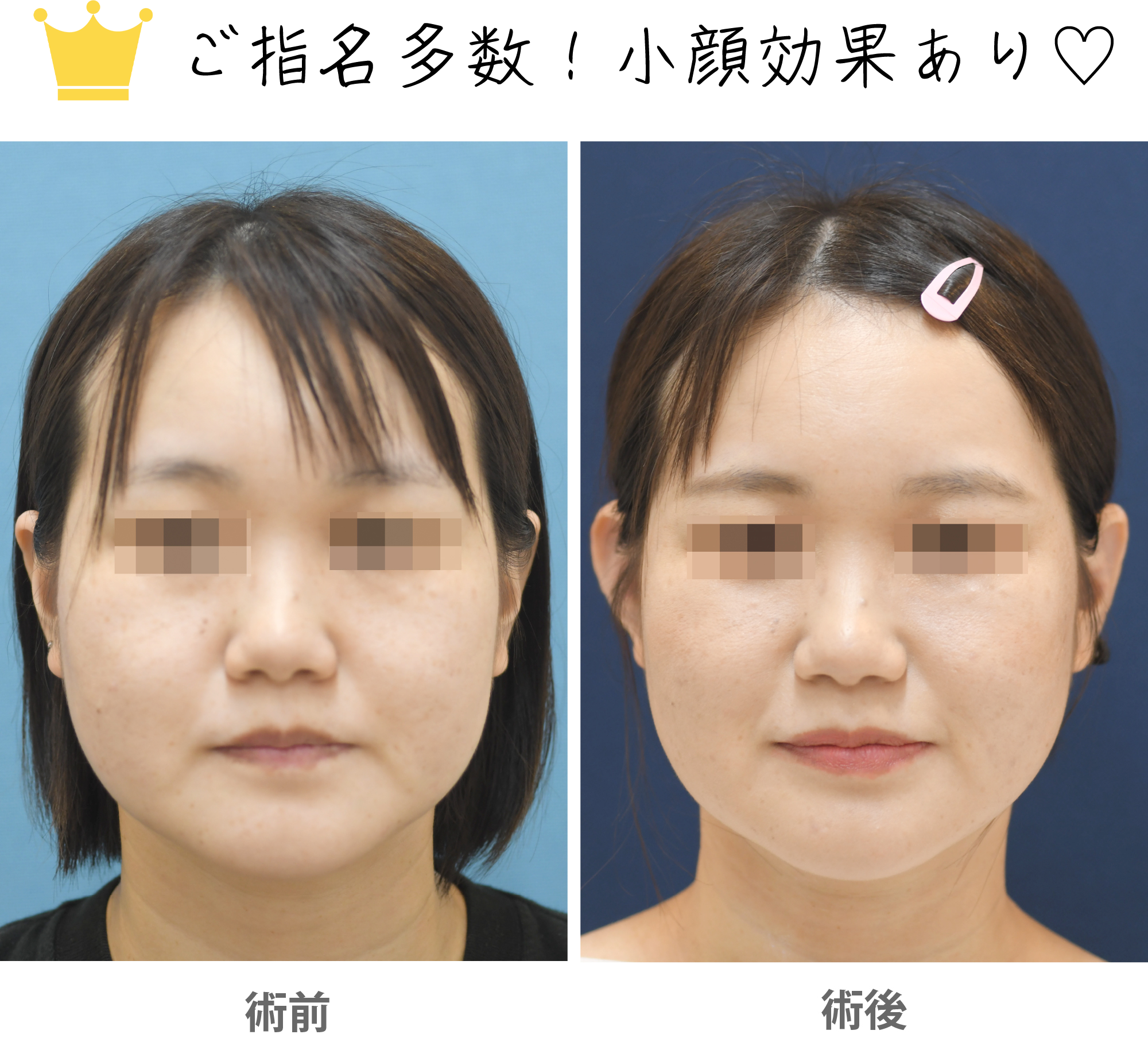 「立ち耳修正（片耳／左右差を整える）」の症例写真・ビフォーアフター