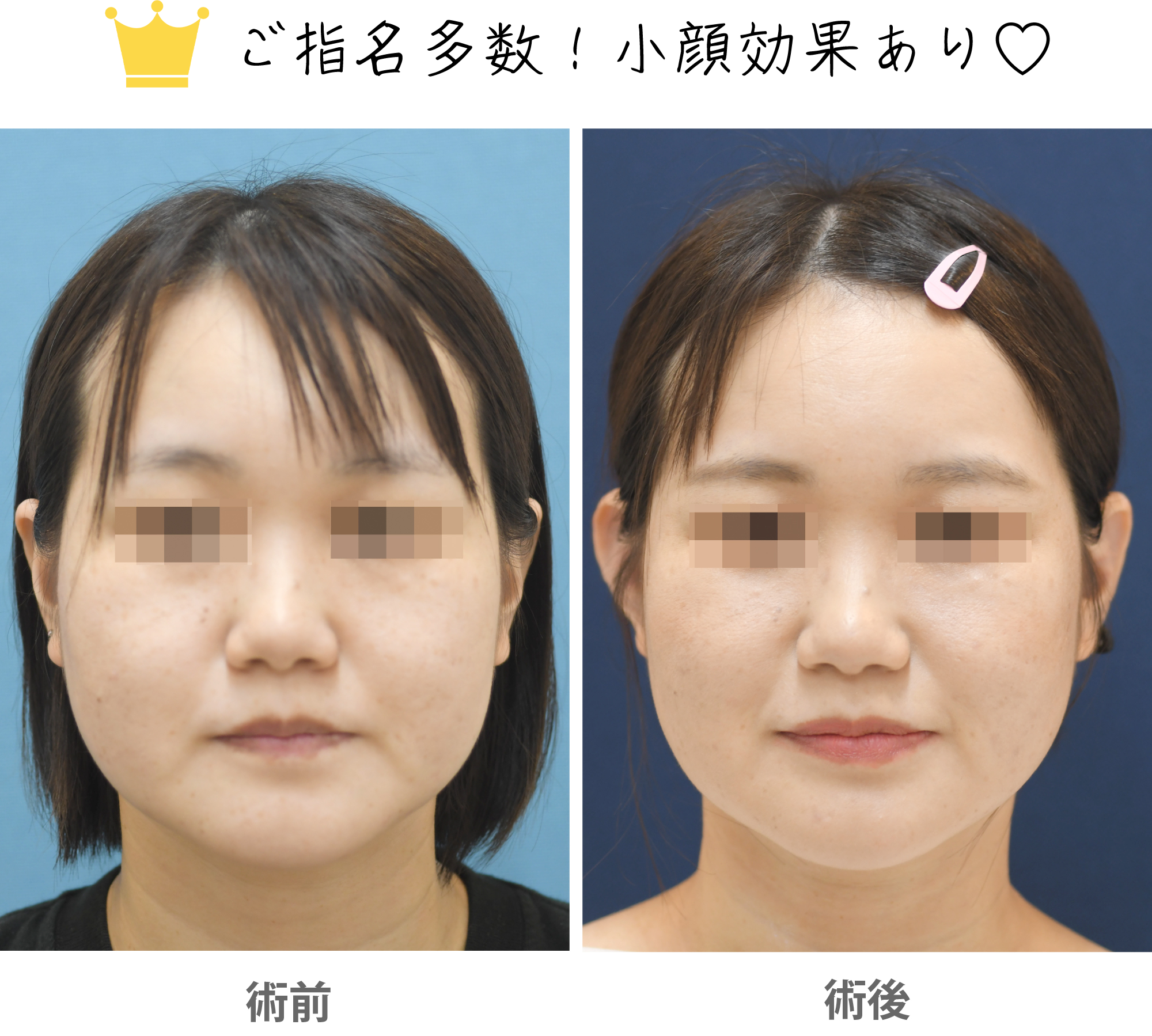 「立ち耳修正（片耳／左右差を整える）」の症例写真・ビフォーアフター