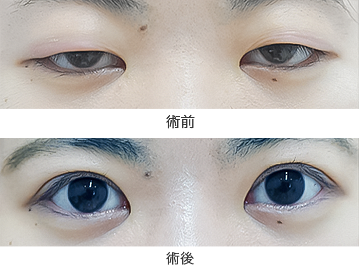 「筋膜移植法」の症例写真・ビフォーアフター