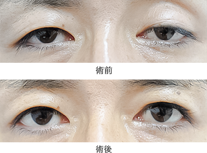 「筋膜移植法」の症例写真・ビフォーアフター