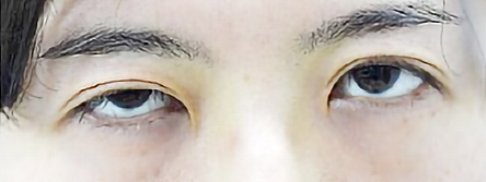 先天性眼瞼下垂