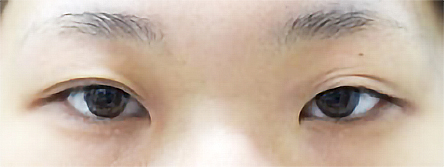 先天性眼瞼下垂