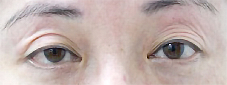 先天性眼瞼下垂