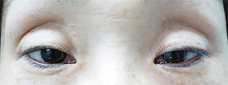 先天性眼瞼下垂