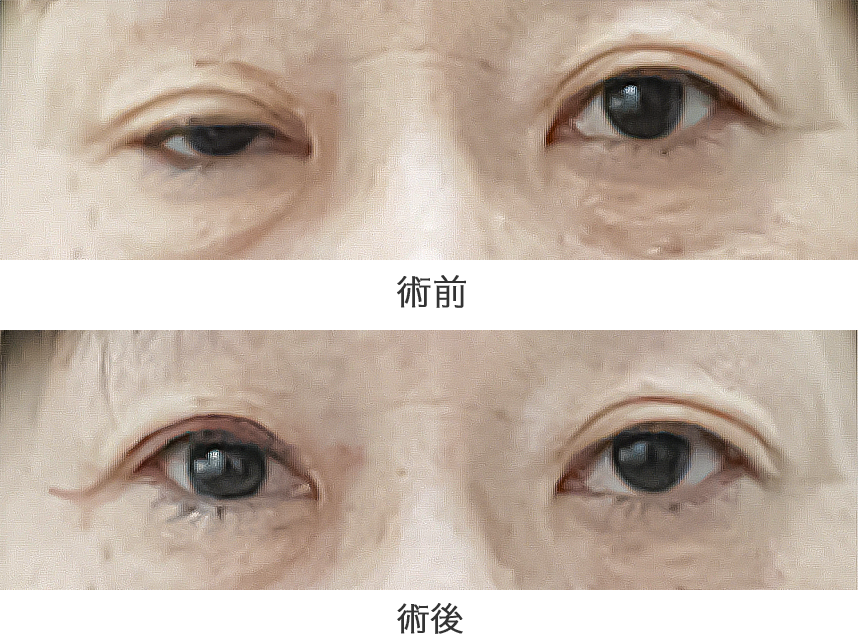 「挙筋腱膜前転法」の症例写真・ビフォーアフター