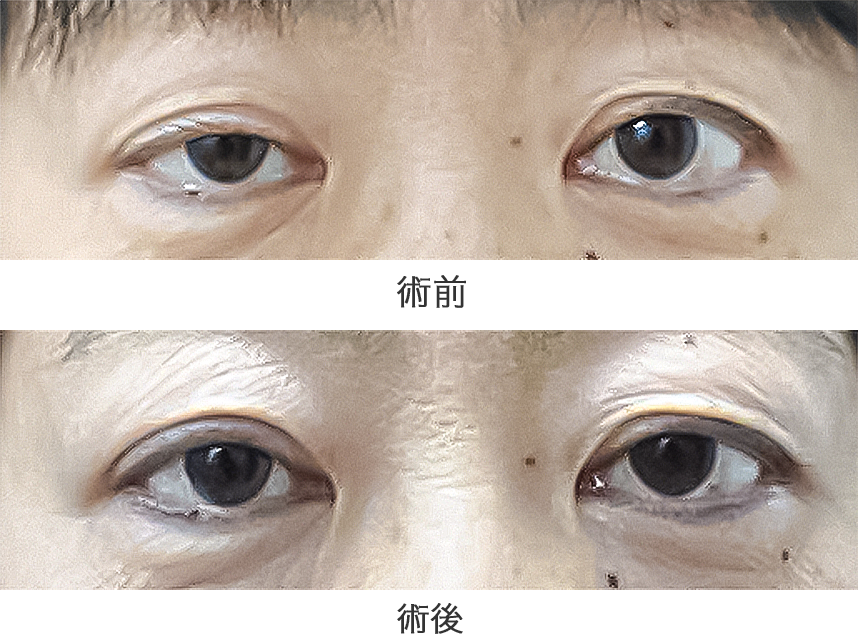 「挙筋腱膜前転法」の症例写真・ビフォーアフター