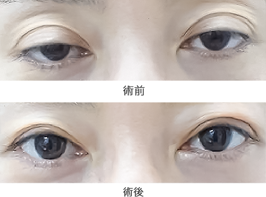 「挙筋腱膜前転法」の症例写真・ビフォーアフター